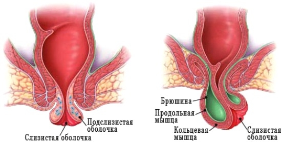 удаление геморроя Киев
