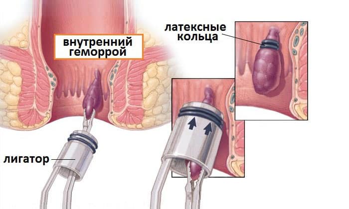 удаление геморроя Подольск