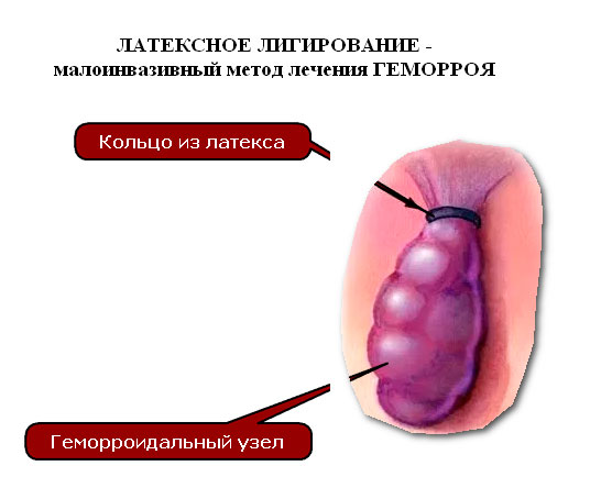 удаление геморроя Подольск