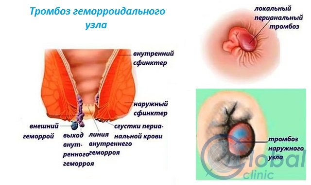 удаление геморроя Подольск