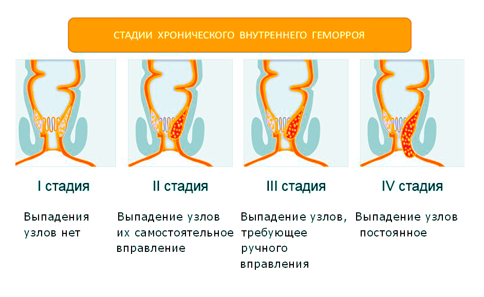 удаление геморроя Подольск