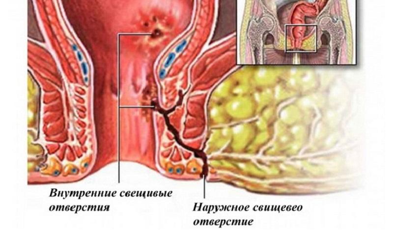 удаление геморроя Подольск