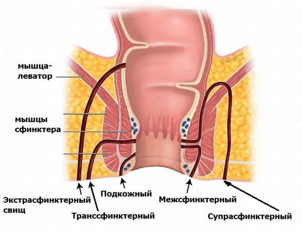 удаление геморроя Подольск