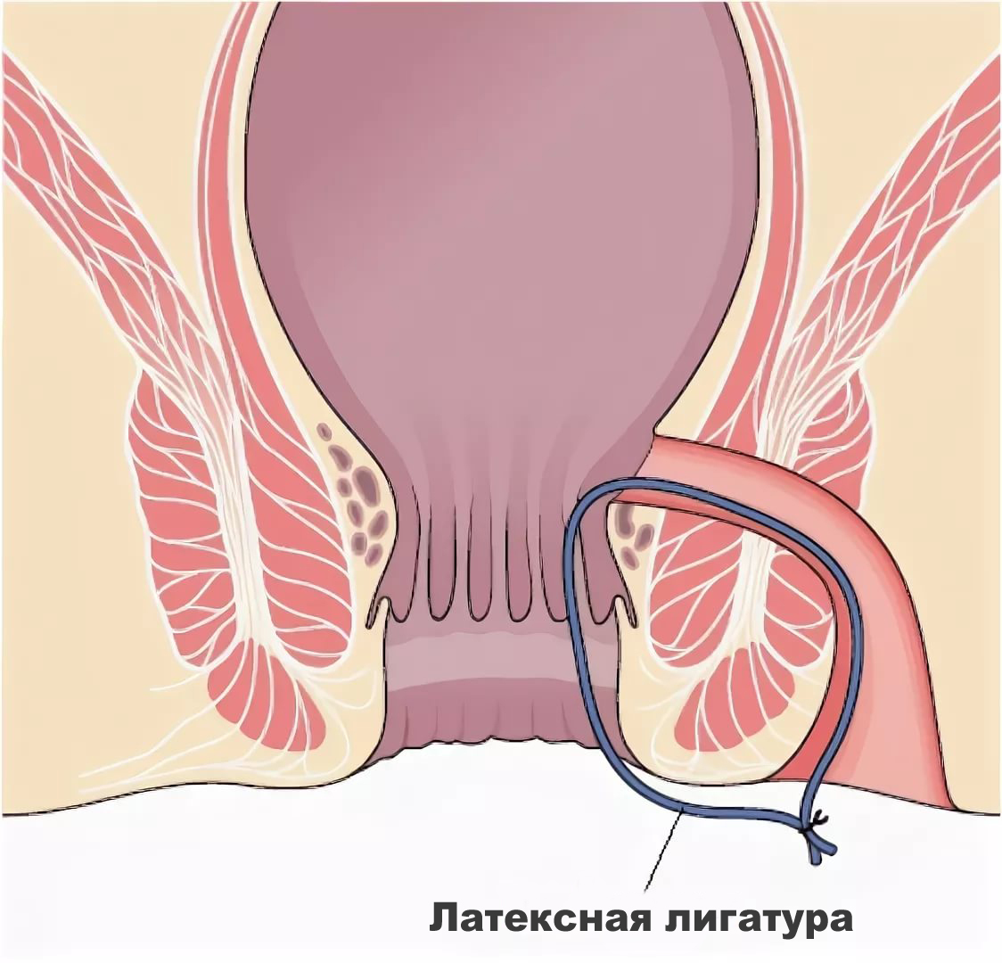 удаление геморроя Подольск