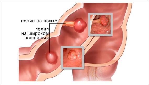 проктолог Подольск Чехов