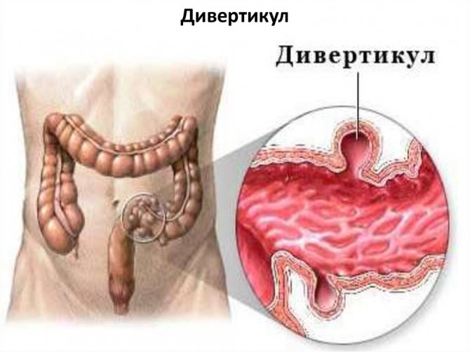 удаление геморроя Подольск