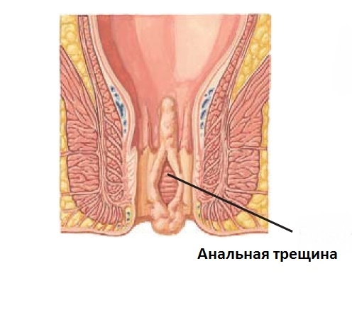 удаление геморроя Подольск