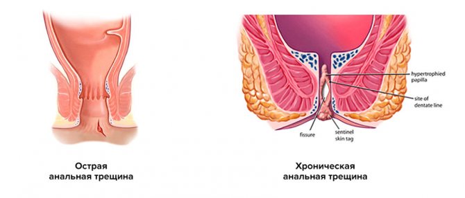удаление геморроя Подольск