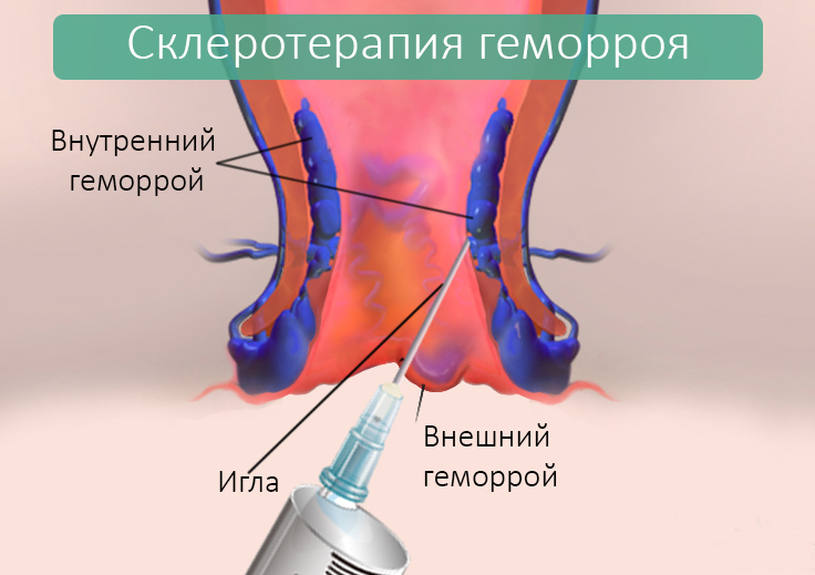 удаление геморроя Подольск