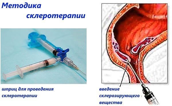 удаление геморроя Подольск